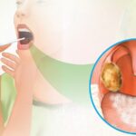 Dấu Hiệu Bệnh Bạch Hầu Và Cách Phòng Bệnh Cần Biết